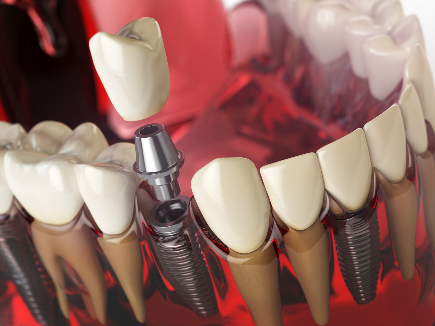 Zahnersatz – Was ist bei der Pflege zu beachten?